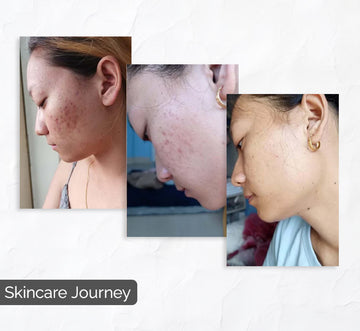 Skin care journey: From acne to clear skin