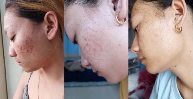 Skincare journey: From Acne to clear skin